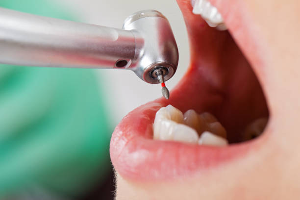 Best Lost Filling or Crown Replacement in Murray, KY